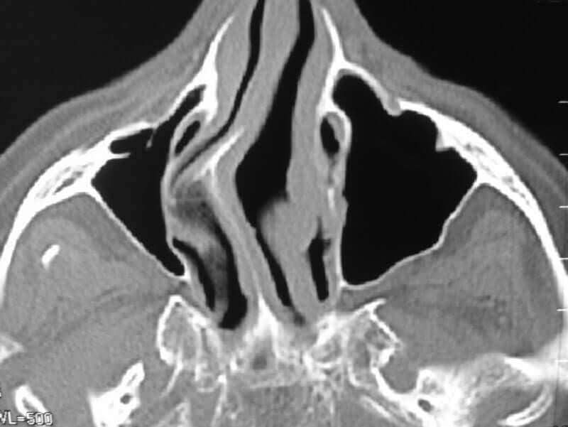 επέμβαση διάφραγμα | Παύλος Τσολαρίδης, M.D.