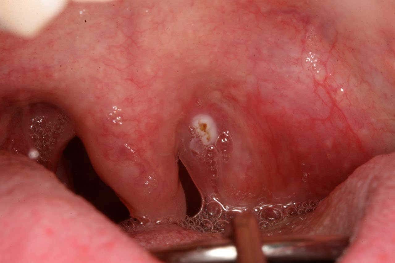 HPV - Herpes στόμα