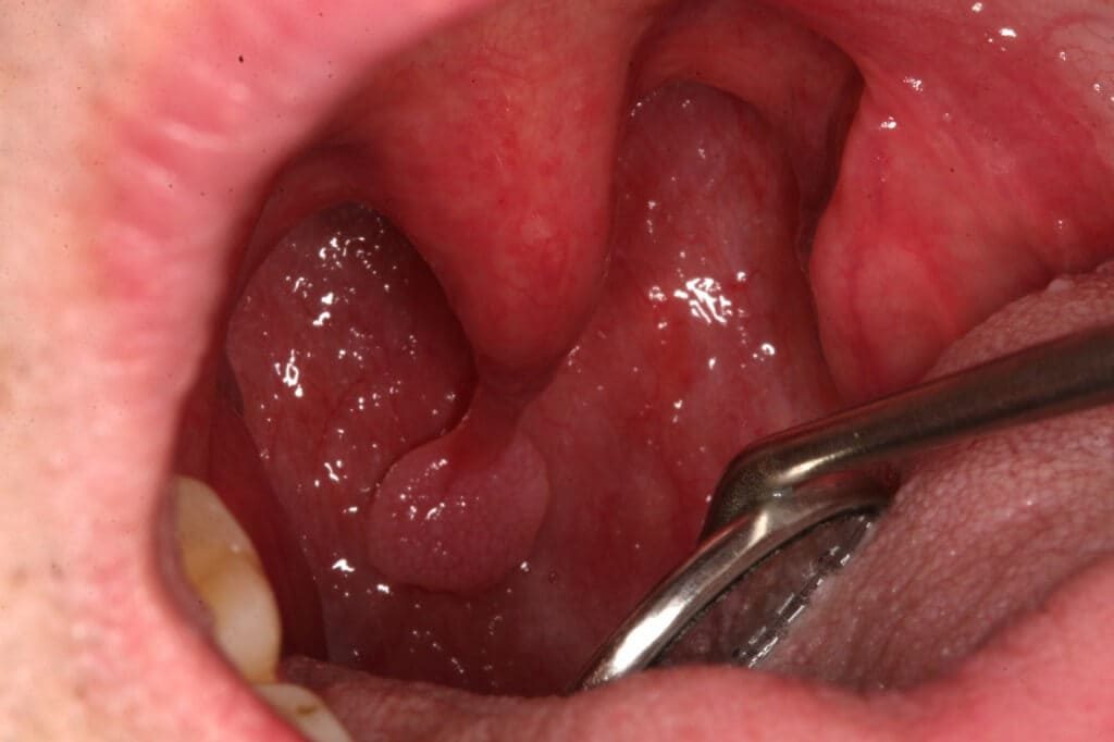 HPV θήλωμα σταφυλής