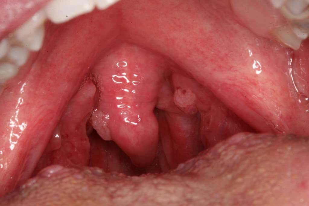 HPV στόμα