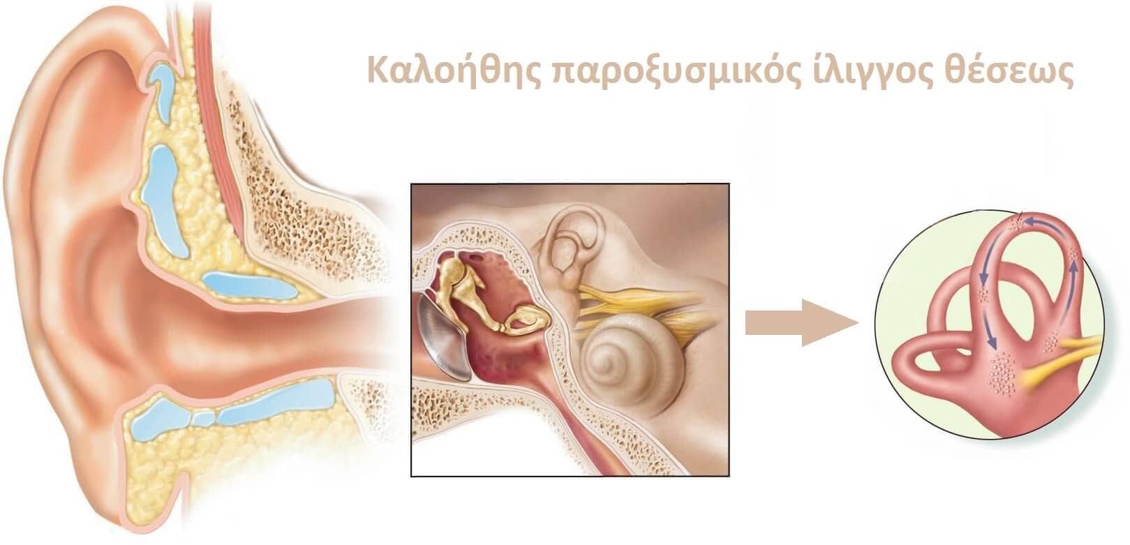 Καλοήθης παροξυσμικός ίλιγγος θέσης (BPPV)